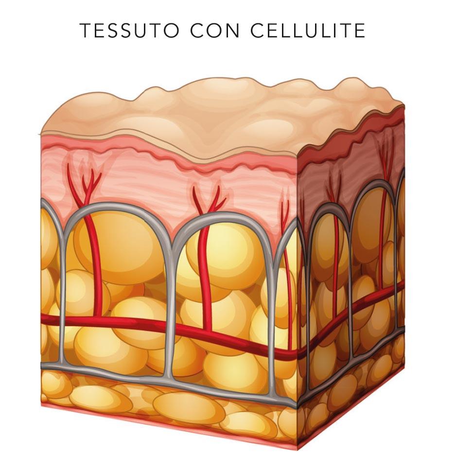 cellulite-tessuto-con-cellulite