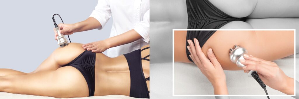 Trattamento corpo radiofrequenza